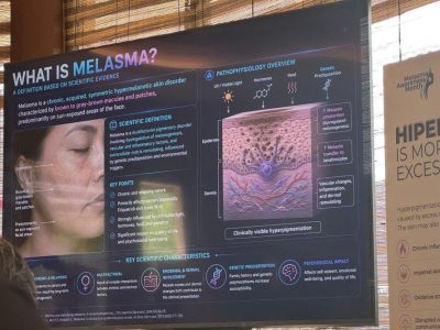 melasma