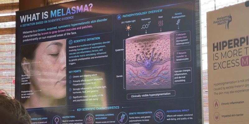 melasma
